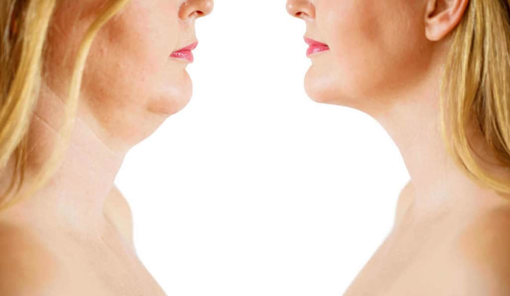 Double Chin treatment Notting Hill before and after results