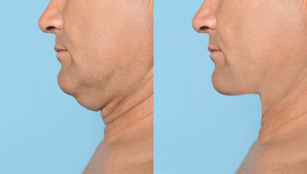 Which Non-Surgical Treatments Work Best for Jowls and Loose Skin Notting Hill?