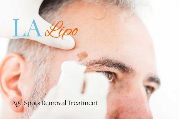 What Are the Most Effective Treatments for Age Spots Notting Hill?