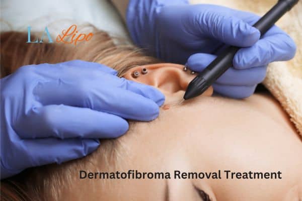 Dermatofibroma Removal Treatment Notting Hill