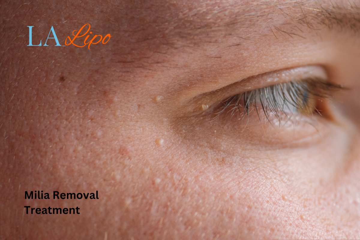Cryopen Milia Removal: Is It the Easiest and Safest Option Notting Hill?