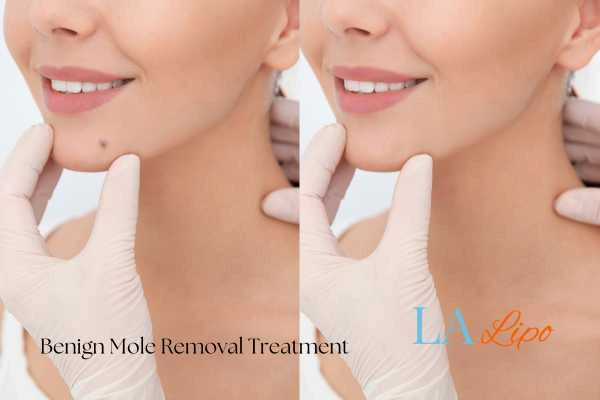 woman's before and after mole removal Notting Hill results