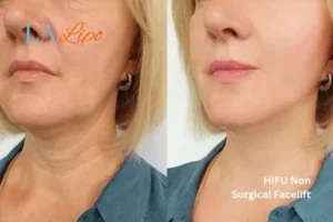 hi-fu for wrinkles Notting Hill before and after results