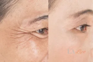 Before and after results of woman - HI-fu wrinkles reduction treatment Notting Hill