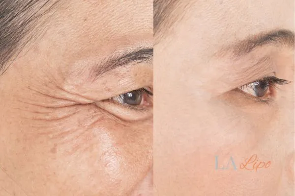 Before and after results of woman - HI-fu wrinkles reduction treatment Notting Hill