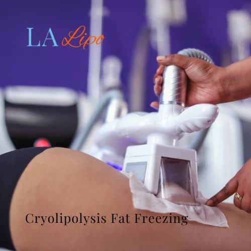 fat freezing - Cryolipolysis Notting Hill