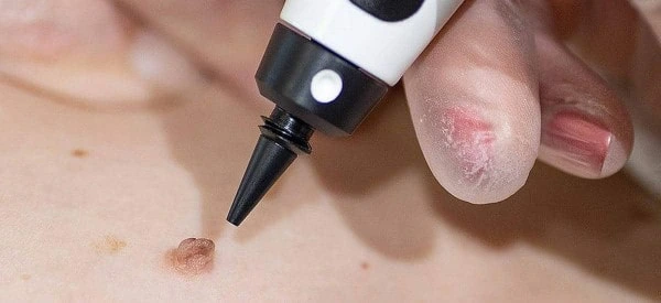 skin tag removal using cryopen Notting Hill