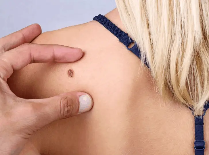 woman having mole removal Notting Hill consultation before treatment.