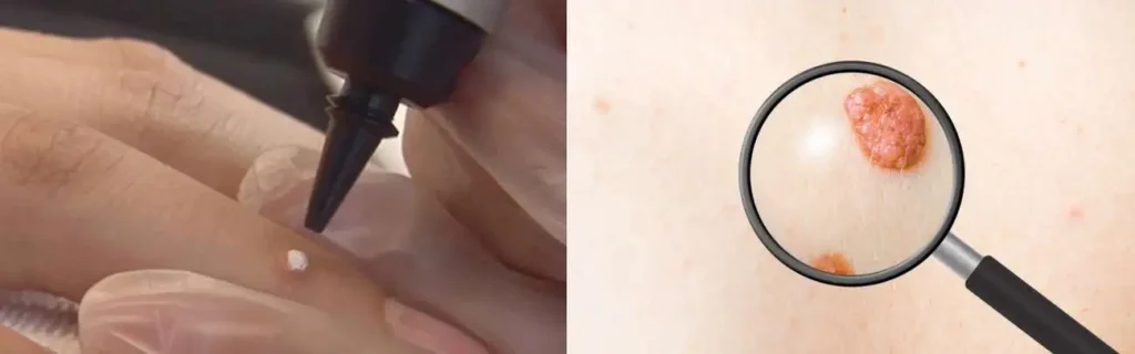 Cryopen for mole removal Notting Hill - speak to our team today!