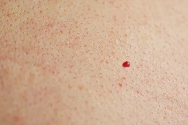 close up of a cherry angioma Notting Hill