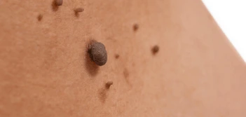 image of a skin tag Notting Hill