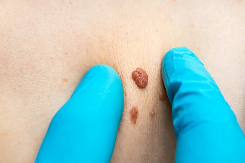 Consultant examining a skin tag Notting Hill