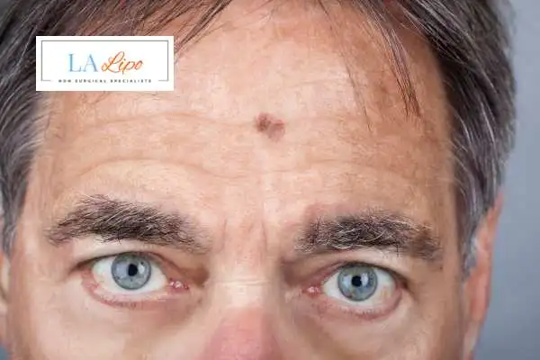 Solar Lentigo Removal Notting Hill image of man with mark on his forehead