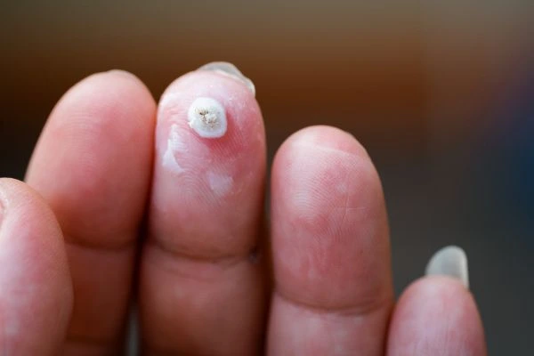 wart on person finger - cryotherapy to treat from LA LIPO Notting Hill