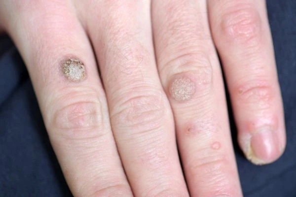 photo of warts on person hand - see wart removal Notting Hill from LA LIPO