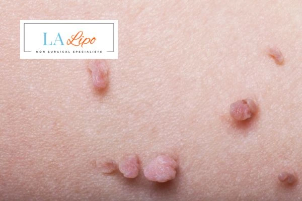Does cryopen skin tag removal Notting Hill hurt? Find out now call our team today!
