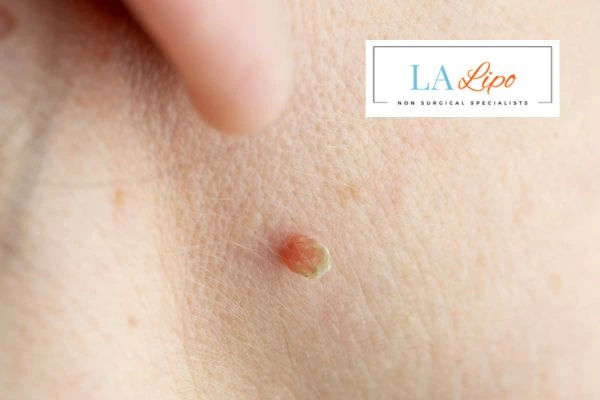 Book skin tag removal Notting Hill today speak to our team now!