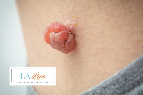 Interested in skin tag removal Notting Hill? Concerned about the pain? Find out more today!