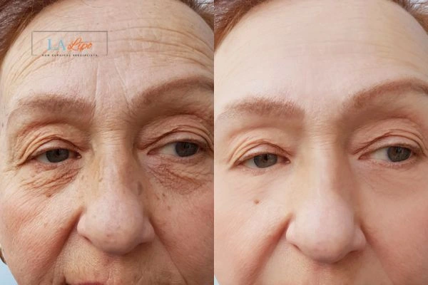 The powerful benefits of Morpheus8 Treatment Notting Hill - Call Our team today!