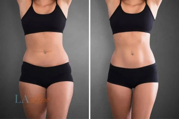 before and after results of non-surgical treatment to help a woman's body image and mental health Notting Hill