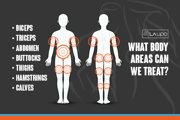 Diagram to show areas you can have LA-EMS Body Sculpting Treatment Notting Hill