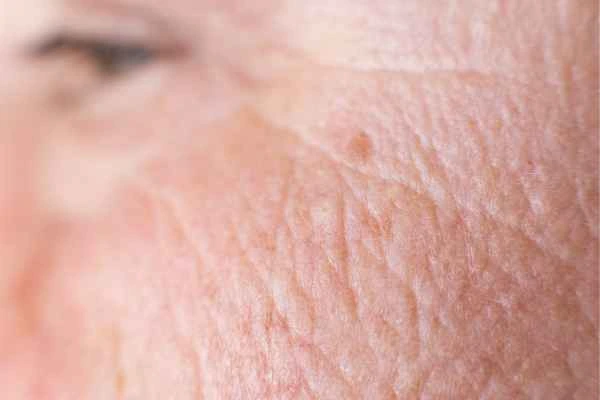 close up picture of a woman's face showing an age spot Notting Hill