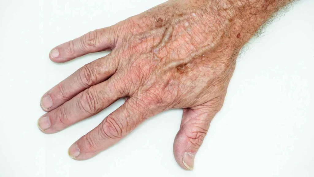 Male hand showing age spot Notting Hill