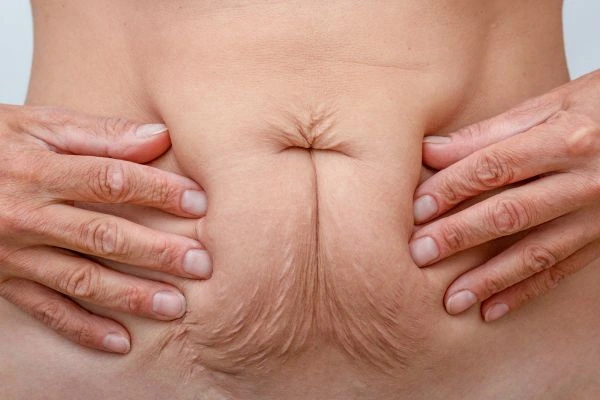 Image of a woman's stomach with loose skin - example of skin tightening Notting Hill options