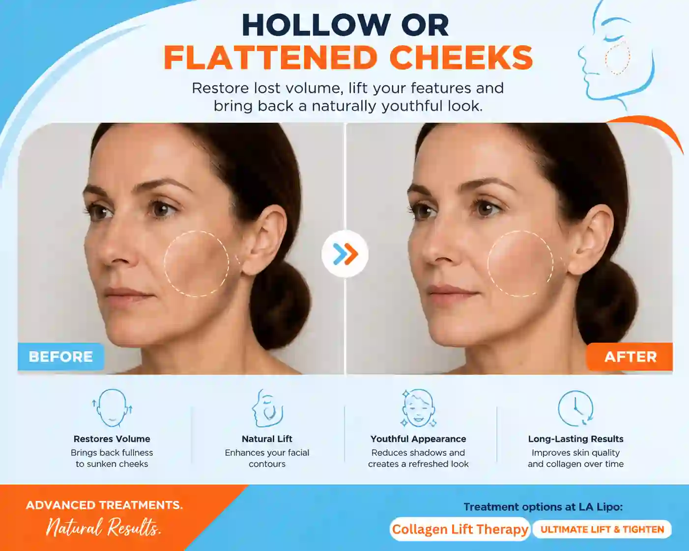 Sign #4: Hollow or Flattened Cheeks Notting Hill